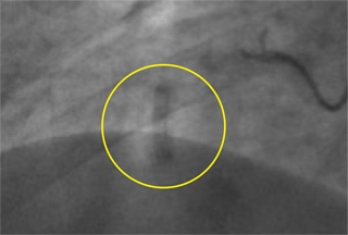 Implant Material